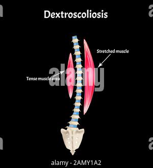 scoliosis Dextroscoliosis. Spinal curvature, kyphosis, lordosis, scoliosis, arthrosis. Infographics. Vector illustration. Stock Vector