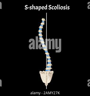 S-shaped scoliosis. Dextroscoliosis. Levoscoliosis. Spinal curvature, kyphosis, lordosis, scoliosis, arthrosis. Infographics. Vector illustration. Stock Vector