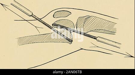 The treatment of fractures . end convalescence. If the separation is