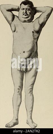 Nervous and mental diseases . Fig. 231.— Macrodactyly: localized ...
