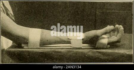 The treatment of fractures . Fig. 315.—Posterior splint, three straps ...