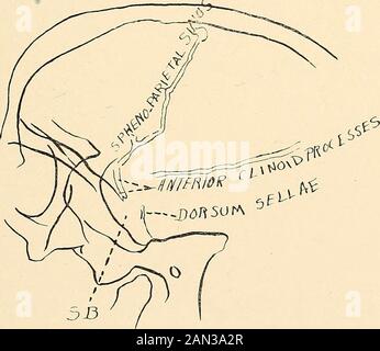 Roentgen diagnosis of diseases of the head . Fig. 95.—A dextrosinistral picture of the head of Case 3. The outline of the sella isquite indistinct due to the fact that it is infiltrated by a carcinomatous growth.. Fig. 96.—A sketch of Fig. 95. SB is the site at which the outlines of the sphenoidbone should be seen. destroyed. One could see only an indistinct contour remaining from thefloor of the sella. Remnants of the dorsum sellae and of the anterior clinoidprocesses were also to be seen. (Figs. 95 and 96.) 258 ROENTGEN DIAGNOSIS OF DISEASES OP THE HEAD Cask 4.— ]&gt;.. Cemale, fifty-two yea Stock Photo