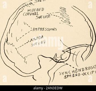 Roentgen diagnosis of diseases of the head . Fig. 86.—A sinistrodextral picture of Case; 1, page 227. Pressure erosions andspreading of the sutures are plainly seen. The case was one of tumor of the cere-bellum. 5AG |TfM- S^oR&. ^0HSS?TUS Fig. 87.—A sketch of Fig. 86. INTRACRANIAL DISEASES 229 On the roentgenogram, the vault of the skull appeared of diminishedthickness. Its inner surface showed deepened impressions. All the sutureswere well preserved and here and there they were gaping. There was nocraniostenosis. Case 4.—M., girl, eight years old. For the last three months has suf-fered from Stock Photo
