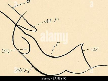 Roentgen diagnosis of diseases of the head . floor to that of the middlecranial fossa diminished and the dorsum of the sella was thin-ned and lengthened. Fig. 4:! represents a variation of this picture. Here one dis-cerns llie existence of a double contour of the floor of the sella INTRACRANIAL DISEASES 169 resulting from a unilateral deepening of the latter in an asym-metrical tumor of the hypophysis. Fig. 44 represents a further progress of the destructioncaused by an intrasellar hypophyseal tumor. One recognizesthe extreme universal deepening of the floor of the sella, thedifference in leve Stock Photo