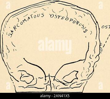 Roentgen diagnosis of diseases of the head . Fig. 29.—An anteroposterior picture of a case of sarcomatous infiltration ofskull. Note the osteoporosis appearing in the vault. At one point the vault appito be perforated. the. OSTEOPHYTES Fig. 30.—Sketch of Fig. 29. Attention is called to the formation of osteophytes on the surface. Case 6.—G., female, fifty-five years old. Pulsating tumor of the skull. The roentgenogram showed, corresponding to this place, an extensive,indistinct, irregularly outlined defect of the bone. The neighboring tissuewas osteoporotic (metastasis from a carcinoma of the Stock Photo