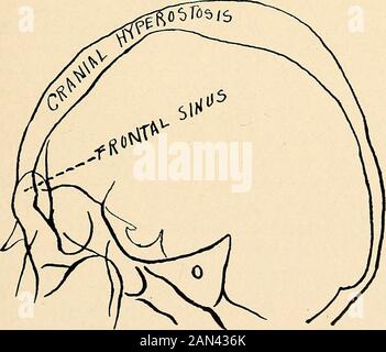 Roentgen diagnosis of diseases of the head . Fg. 25.-.—Diffuse hyperostosis of the skull in the patient discussed in Case 4.. Fig. 26.—Sketch of picture in Fig. 25. V. Eiselsberg described some interesting cases of hyperosto-sis, the roentgenograms of which we had occasion to take, andthey are discussed beloAV. In our collection there are roentgenograms of several cases 136 ROENTGEN DIAGNOSIS OF DISEASES OF THE HEAD (if diffuse or tumor-like hyperostosis. Several of these may becited here briefly: Case 1.—Boy, five years old. Imbecile. The skull appeared enlarged,hydrocephalic in shape, and as Stock Photo