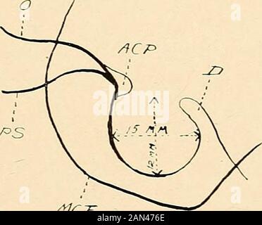 Roentgen diagnosis of diseases of the head . Fig. 17.—The picture of an adult cretin showing the characteristic shape of the head.. S&gt;S S1CT Fig. 18.—A drawing of the sella turcica as seen in the x-ray plate of the headof an adult cretin. The dimensions as given show it to be concentrically enlarged. skull base and the flatness of the skull fossas to be established.Finally, one recognizes very plainly in the roentgenogram theprognathia of the upper jaw and the position of the nose. Oneis convinced that the root of the nose is not only drawn down,but also is forced down abnormally low, a det Stock Photo