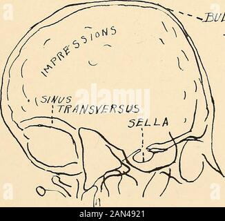 Roentgen diagnosis of diseases of the head . Fi&lt;*. 11.—The sinistrodextral roentgen picture of a 14-year-old boy with a turri-cephalus, mentioned on page 72. Attention is called to the generalized erosion overthe inner surface of the skull and the visible impression made by the transverse sinus.The lighter area in the region of the bregma is probably due to erosion caused by thepressure of Pacchionian bodies.. -BULGINGStEGMA Fig. 12.—Sketch of Fig. 11. There is some concentric dilatation of the sella,characteristic turricephalic contour of the head. Note the 74 ROENTGEN DIAGNOSIS OF DISEASE Stock Photo