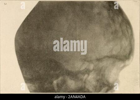 Roentgen diagnosis of diseases of the head . ?pLUNOrt5PHEN0IDAL 5ptftr/f01IML T-^^-3/NUS FL 00 ft o F C/JAN1AL Fossa Fig. 7.—This is a line drawing of the prominent features found in Fig. 6, and intendedas an aid in reading the details of the plate. 54 ROENTGEN DIAGNOSIS OP DISEASES OP THE HEAD. Fig. 8.—A sinistrodextral exposure of a hydrocephalic head. The mottling dueto pressure atrophy is very noticeable in this instance. It is the picture of the headof Case 7. Stock Photo
