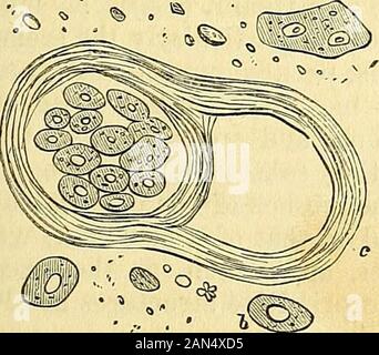 A system of surgery : pathological, diagnostic, therapeutic, and operative . Epithelial cancer in a state of ulceration.. Stock Photo