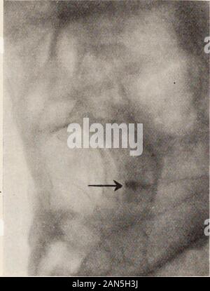 journal of ophthalmology otology and laryngology themetal but without success eye enucleated and conjunctival woundclosed by means of a purse string suture which was taken out eightdays later very severe cellulitis developed otherwise an uneventfulrecovery prothesis was inserted within three weeks examination of eyeball showed metal imbedded in scleral tissue 170 report six cases of eye injury which required enucleation and absolutely immovable due to sharp serrated edges vision of righteye brought up to normal by means of correcting lens as he had myopicastigmatism case 4 name 2an5h3j