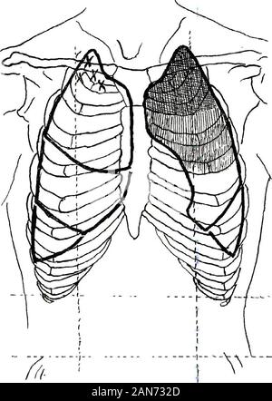 The signs of internal disease, with a brief consideration of the principal symptoms thereof . t murmurs.) To sum up the signs already elaborated, whichallow of the diagnosis of beginning tuberculosis with almost as greatcertainty as does the finding of tubercle bacilli in the sputum, andoften long before their occurrence therein, we append the following:, Modification of vesicular murmur at apex. / Adventitious sounds, arterial or respiratory, limited to the apex.Percussion dullness in clavicular area or supra-spinous fossa. bigns of y Increased fremitus. , Impaired expansion or flattening of Stock Photo