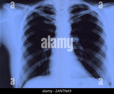 X-ray of the lungs of a healthy person. Female chest x-ray film. Close-up Stock Photo