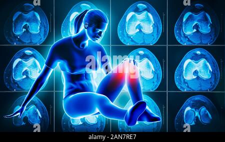 Young athletic woman laying on the ground holding her painful and injured knee with left knee CT scan in the background. Sport, medical and healthcare Stock Photo