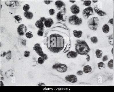 Report of first expedition to South America, 1913Members of the expedition: Richard PStrong [and others] . ^... j^ Fig. 1. — Liver. Showing endothelial phagocytes in sinusoid.. Fig. 2. — Lymph-node. Showing swollen endothelial cell in blood-vessel wall. Plate XVL — Oroya Fe-er. HISTOPATHOLOGY 53 and that a paratyphoid baciUus had been isolated from thespleen. Possibly the organism encountered in this case was aspecies of paracolon or colon bacillus, and a terminal invaderin a case of Oroya fever. In the light of our own observationsthe changes described in the sections of the liver by De Vecc Stock Photo