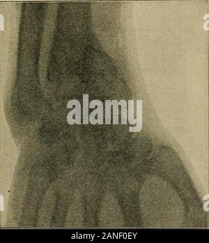 X-ray of the fingers of the left hand in a patient showing osteitis ...