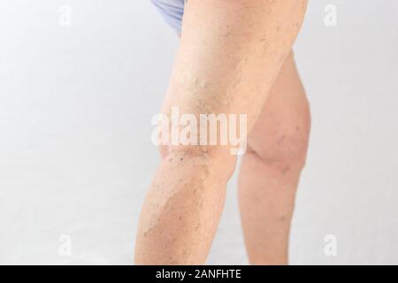 Varicose veins on the woman's foot over white background Stock Photo