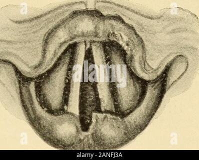 A text-book on diseases of the ear, nose and throat . Stock Photo