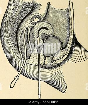 The electro-therapeutic guide, or, A thousand questions asked and answered . etro-flexion. Utero-Vesical Farad-isation Ante-flexion. Utero-Rectal Farad-isation Stock Photo