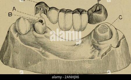 A practical treatise on artificial crown- and bridge-work . also being considerably retrenched; D, the crown-plate of apartial cap, made of pure gold, soldered with 20-carat gold, andso constructed as to cover every portion of the tooth except its Fig. 48-3.D-. buccal surface, the free edge passing up under the gum; E, a retaining-pin adapted to the opening B; F, the gold cap for the molar. Fig. 486. Stock Photo