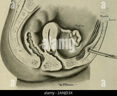 Simpsons Maypole Intestines . Gynecology : . itleaves two openings on the sides through which the ...