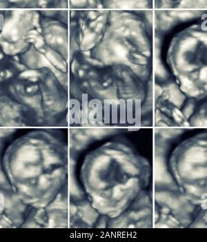 Pictures of 4D Ultrasound of baby in mother's womb. Collage of 3D Echography images. Stock Photo