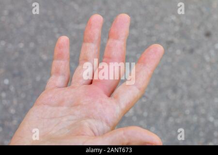 a right hand with a bee, wasp bite mark, swelling hand, swollen finger, hand after a bee sting, bite Stock Photo