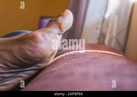 a callus on the big toe of an African woman that is caused by ill fitting shoe Stock Photo