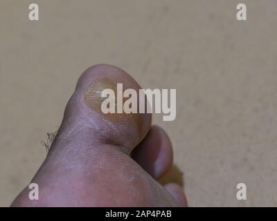 a close up picture of callous on a big toe of a person. it is usually caused by friction or ill fitted shoe Stock Photo
