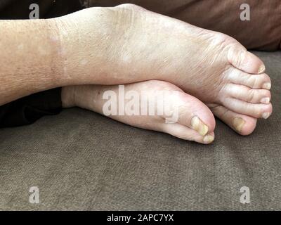 feet of a patient who has pulmonary edema with damaged nails because of fungus and athlete Stock Photo