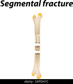 Segmental fracture Bone. Infographics. Vector illustration on a lined background. Stock Vector