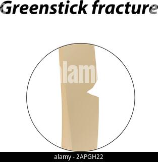 Greenstick fracture Bone. Infographics. Vector illustration on a lined background. Stock Vector