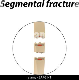 Segmental fracture Bone. Infographics. Vector illustration on a lined background. Stock Vector