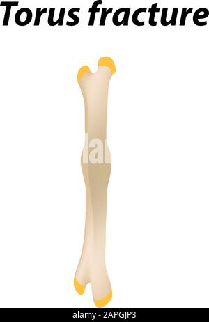 Torus fracture Bone. Infographics. Vector illustration on a lined background. Stock Vector