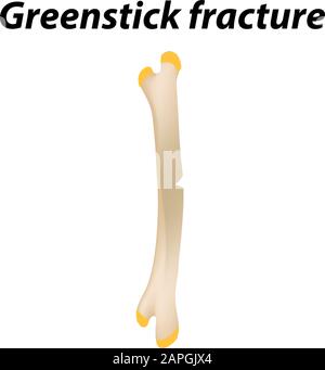 Greenstick fracture Bone. Infographics. Vector illustration on a lined background. Stock Vector