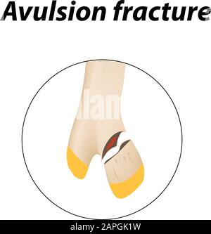 Avulsion fracture Bone. Infographics. Vector illustration on a lined background. Stock Vector