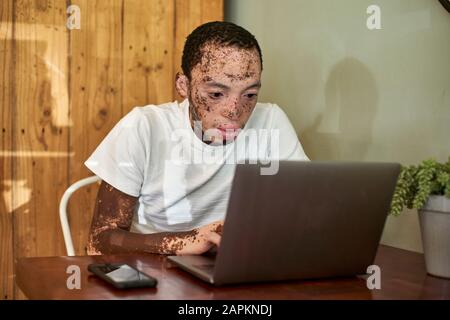 Young man with vitiligo working on his computer in a cafeteria Stock Photo