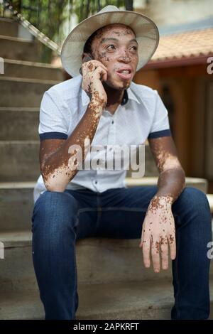 Young man with vitiligo using smartphone Stock Photo