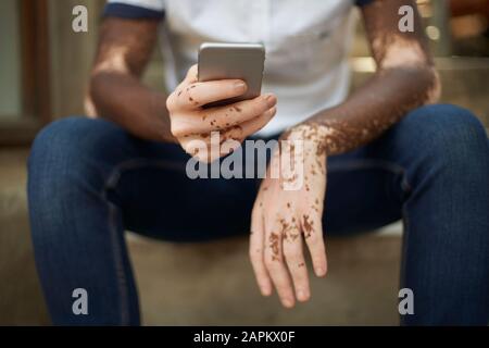 Young man with vitiligo using smartphone Stock Photo
