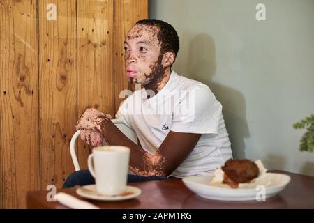 Young man with vitiligo sitting in a cafeteria with a coffee and a muffin on the table Stock Photo
