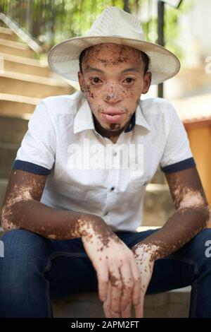 Portrait of young man with vitiligo wearing a hat and sitting on the stairs Stock Photo