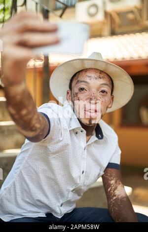 Young man with vitiligo using smartphone and taking a selfie Stock Photo