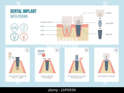 Dental implant medical procedure and structure, dentistry and orthodontics concept Stock Vector