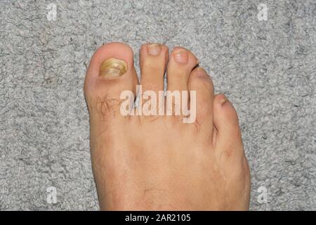 Young Man barefoot fingers with onycho mycosis nails sick,dermatologic issues Stock Photo