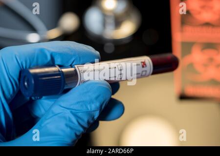 Coronavirus positive blood test sample for sick patient. Infected blood sample of Wuhan coronavirus. Research laboratory test results for respiratory Stock Photo