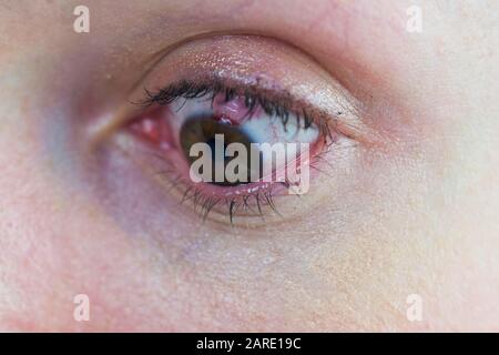 Eye with bloody sclera from laser eye surgery damage. Blood cells in eye, visiblely bloodshot. Makeup wearing female Stock Photo