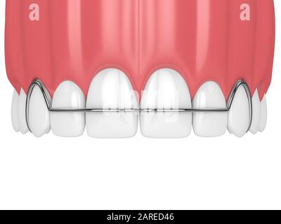 3d render of jaw with orthodontic removable retainer over whte background Stock Photo