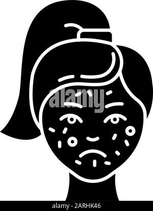 Girl with Pimples on Face flat Icon. Woman with Blackhead, Acne, Rash ...