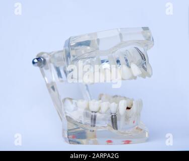 Dentists tooth plastic model with screw implant for teaching, learning and patients in dental office showing teeth and gums. Stock Photo