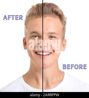 Teenage boy after and before acne treatment on white background Stock Photo